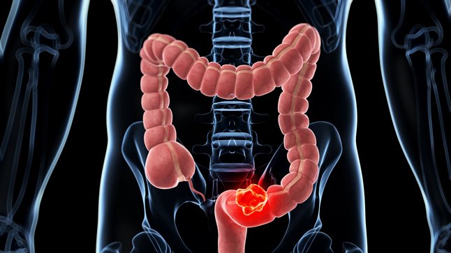 cancer-colon